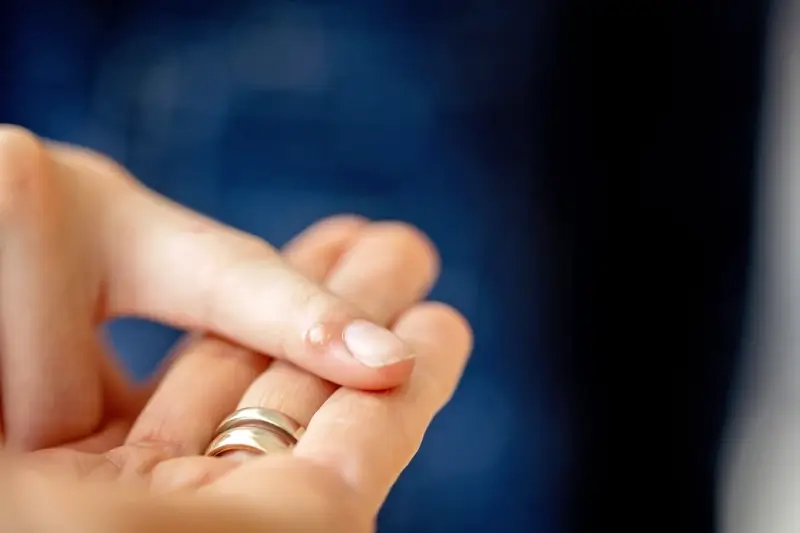 Jak sie pozbyc kurzajki?