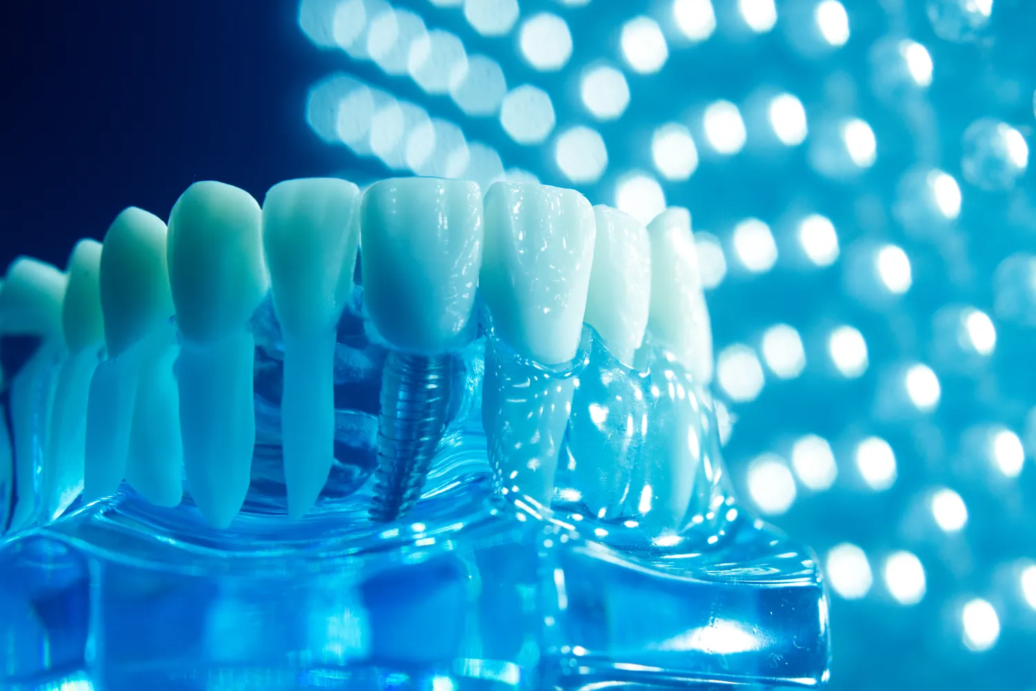 Jak wyglądają implanty zębowe?