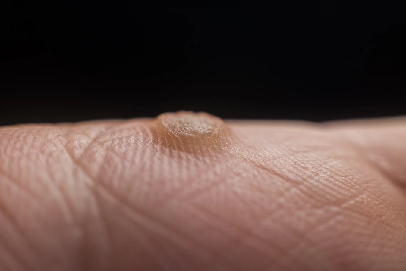 Co na kurzajki na stopie u dziecka?