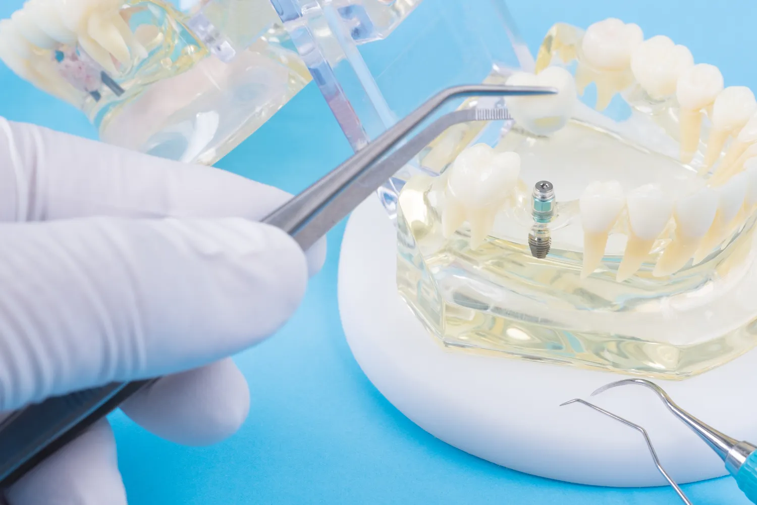 Ile czasu trwa leczenie kanałowe?